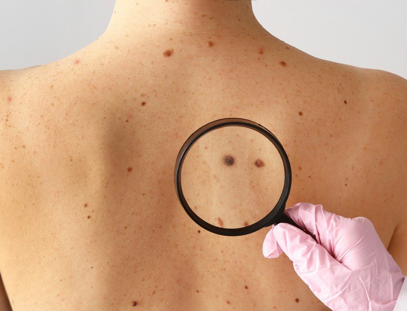 Nuevas tecnologías y melanoma: “Cada vez tenemos diagnósticos más precoces y mejores tratamientos”